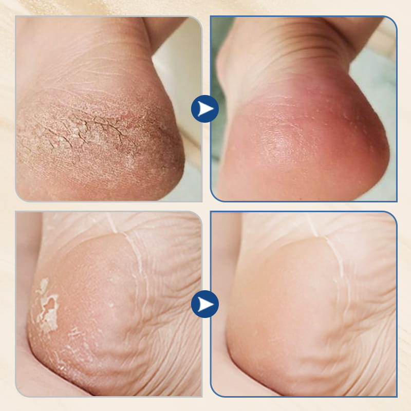 🔥 HEISSER VERKAUF 🔥 Feuchtigkeitsspendende & Anti-Riss-Fußcreme – Intensive Feuchtigkeit, Repariert trockene & rissige Fersen, Weicht raue Haut auf ✨